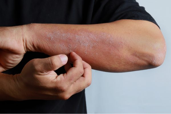 DERMATITE ATÓPICA