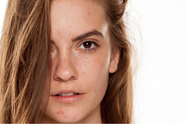 MELASMA