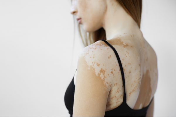 VITILIGO