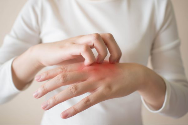 DERMATITE DE CONTATO